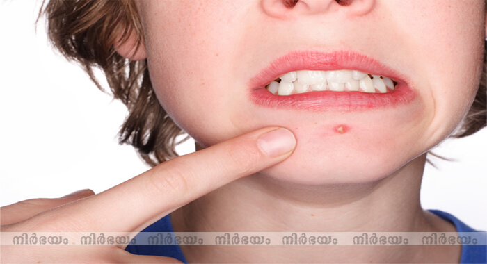 homemade-tips-for-pimples