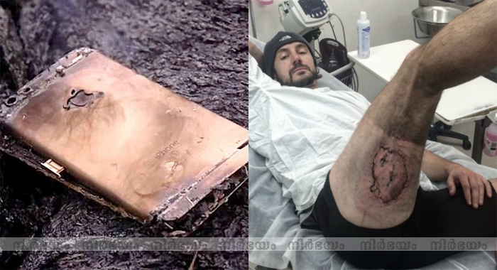 iphone-6-explodes-in-a-mans-back-pocket-leaves-him-with-serious-burn-injuries
