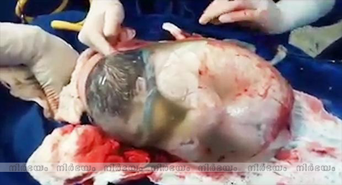 incredibly-rare-moment-a-baby-is-born-inside-the-amniotic-sac