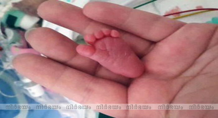 meet-the-worlds-smallest-baby-after-being-born-weighing-8-ounces