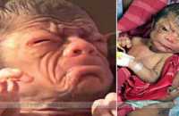 newborn-baby-who-looks-like-an-80-year-old-after-being-born-with-rare-ageing-condition
