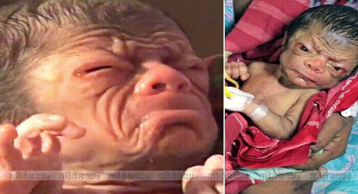 newborn-baby-who-looks-like-an-80-year-old-after-being-born-with-rare-ageing-condition