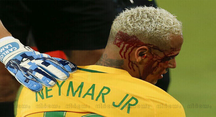 bloody-neymar-removed-from-brazil-match-vs-bolivia-after-elbow-to-face