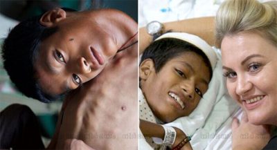 boy-cursed-with-no-neck-muscles-leaving-his-head-permanently