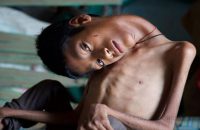 boy-cursed-with-no-neck-muscles-leaving-his-head-permanently