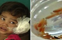 girl-has-80-worms-removed-from-her-ear-after-insect-attracted-to-dirty-conditions-entered-her-body