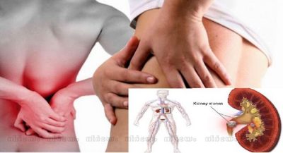 kidney-stone