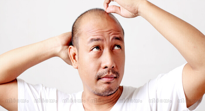 reasons-for-bald-man