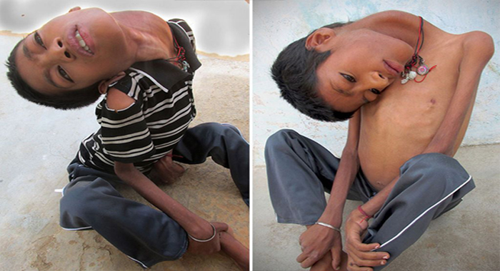 indian-teenager-dies-just-eight-months-after-life-changing-surgery