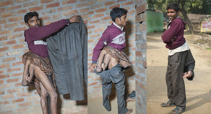 man-with-four-legs-pleads-for-doctors-to-remove-the-extra-limbs