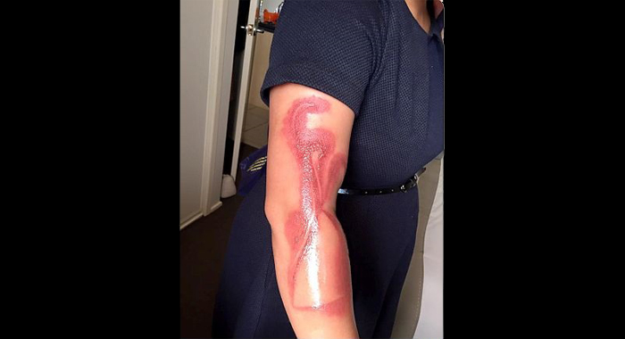iphone-7-allegedly-burns-woman-while-sleeping