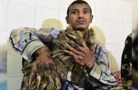 bangladesh-tree-man-sees-hope-after-16-surgeries