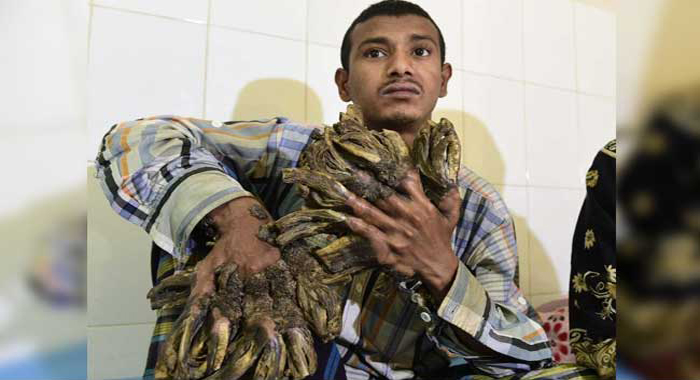 bangladesh-tree-man-sees-hope-after-16-surgeries