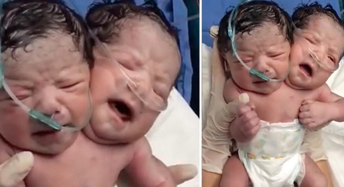 conjoined-twins-who-share-a-single-body-with-two-heads-cry-moments-after-being-born