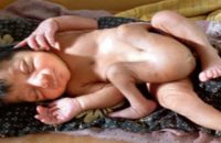 woman-gives-birth-to-baby-with-4-legs-2-male-sex-organs