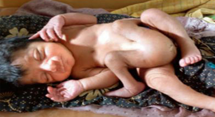 woman-gives-birth-to-baby-with-4-legs-2-male-sex-organs