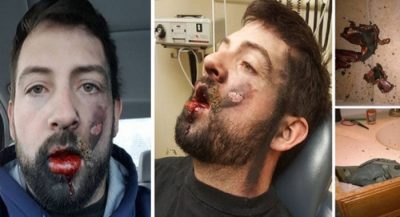e-cig-explodes