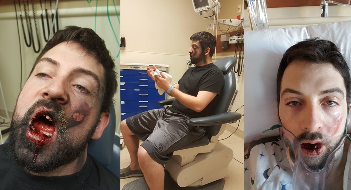 e-cig-explodes-idaho-mans-face-loses-7-teeth-suffers-second-degree-burns