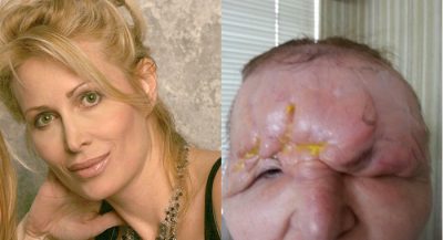 woman-dermal-fillers-ruin-cosmetic-surgery-carol-bryan-los-angeles-florida