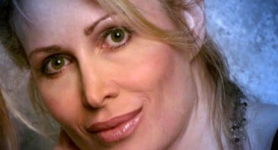 woman-dermal-fillers-ruin-cosmetic-surgery-carol-bryan-los-angeles-florida1