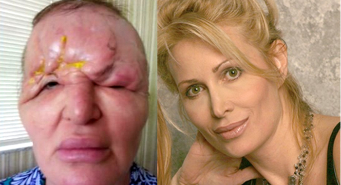 woman-dermal-fillers-ruin-cosmetic-surgery-gone-wrong-face-ruin-carol-bryan-los-angeles-florida