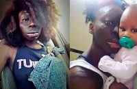 burns-victim-refuses-surgery-loves-scars