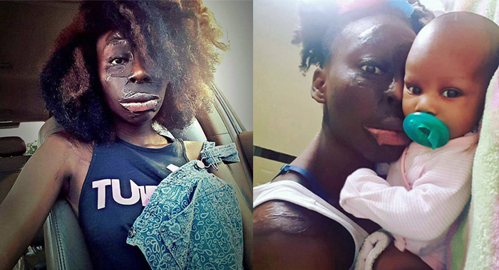 burns-victim-refuses-surgery-loves-scars