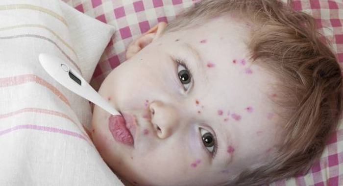 chickenpox-season-is-here-and-this-is-what-you-should-do