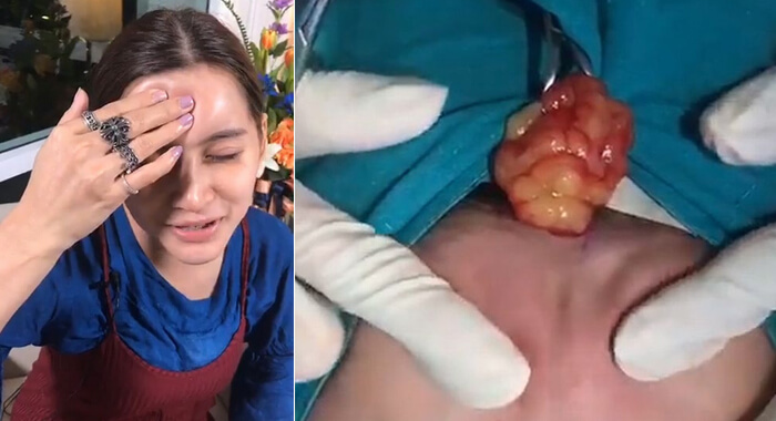 stomach-churning-moment-woman-gets-infected-plastic-surgery-filler-squeezed-out-of-forehead