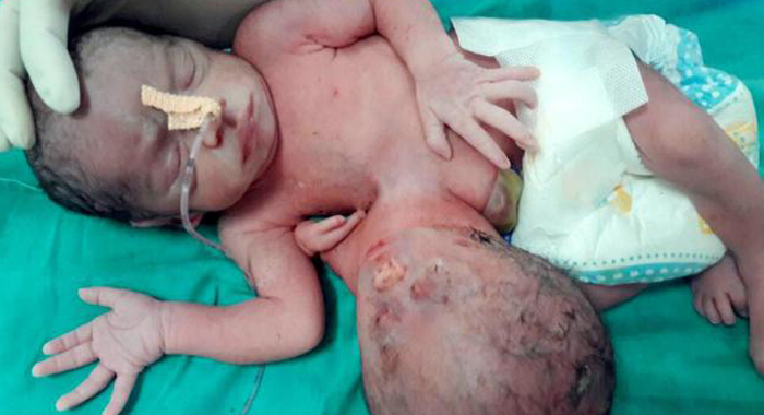 indian-baby-born-with-two-heads-one-on-stomach