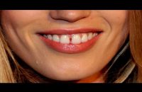 what-is-the-gap-infront-your-teeth-indicates