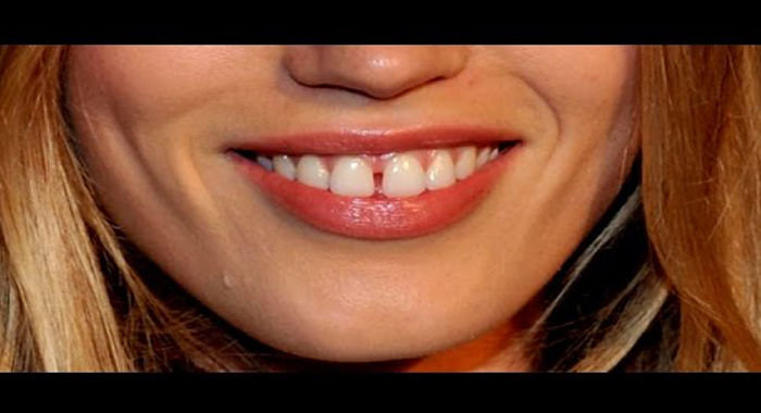 what-is-the-gap-infront-your-teeth-indicates