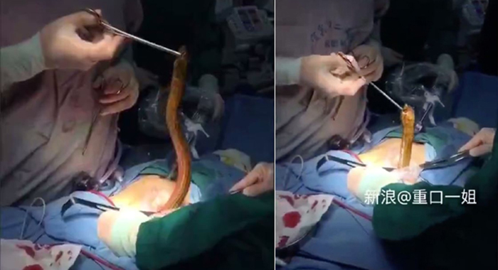 footage-shows-live-eel-being-removed-from-patients-body