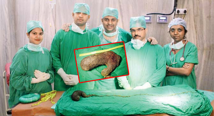 mumbai-doctors-remove-750-grams-of-hair-from-womans-stomach