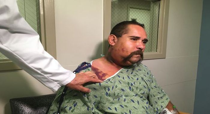 man-bitten-in-face-by-rattlesnake-while-trying-to-cook-it