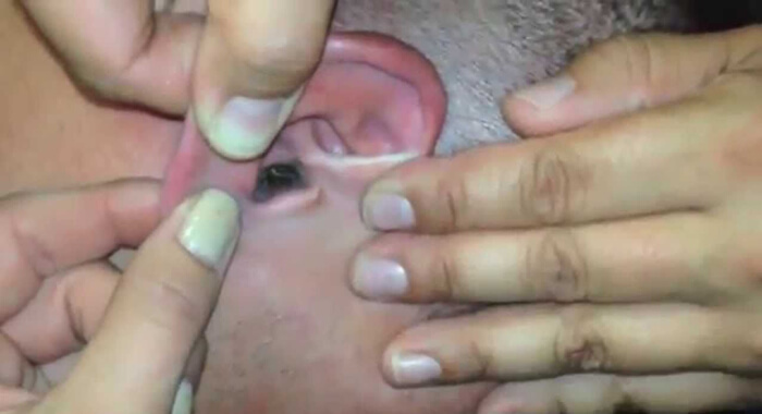 bug-in-ear-first-aid