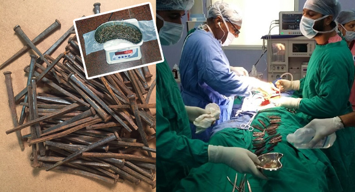 doctors-extract-639-nails-from-a-mans-intestine