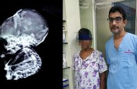 baby-aborted-15-years-back-found-in-women-stomach