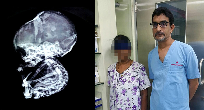 baby-aborted-15-years-back-found-in-women-stomach