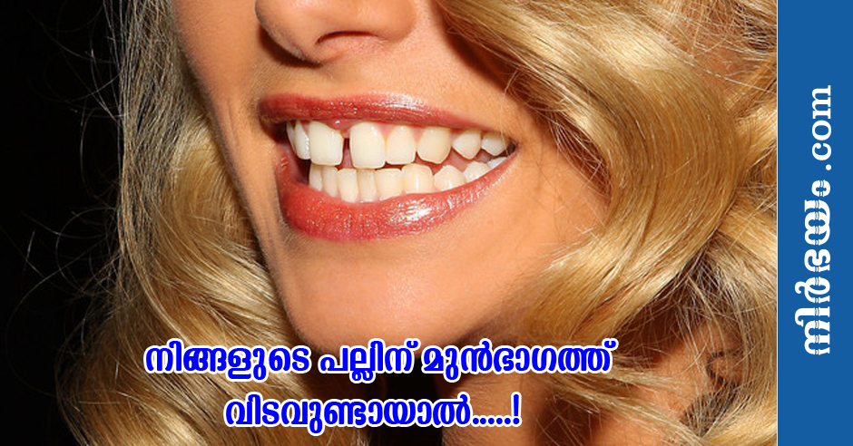 gap-between-front-teeth