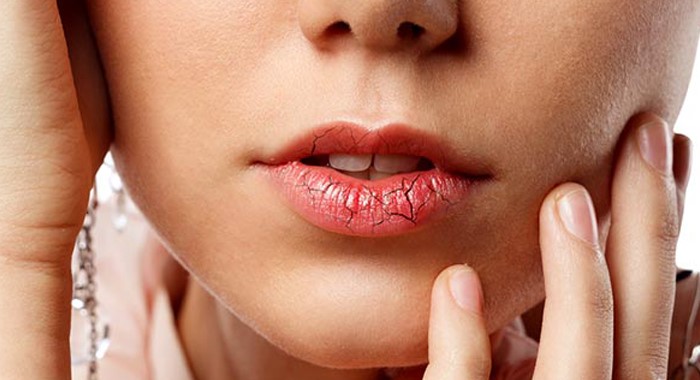 home-remedies-for-chapped-lips