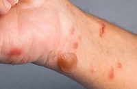 burn-injury-types-and-treatment