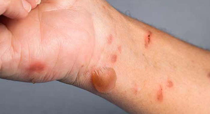 burn-injury-types-and-treatment