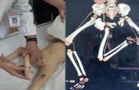 chinese-baby-born-with-three-legs-has-extra-limb-removed