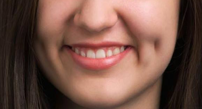 do-you-know-enough-about-dimples