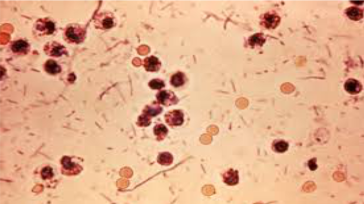 shigella-bacteria-infection-signs-and-symptoms