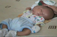 conjoined-twin-two-month-old-boy-has-an-extra-face-and-brain