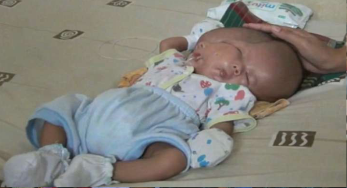 conjoined-twin-two-month-old-boy-has-an-extra-face-and-brain