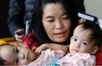conjoined-twins-flown-from-bhutan-to-australia-for-separation-operation