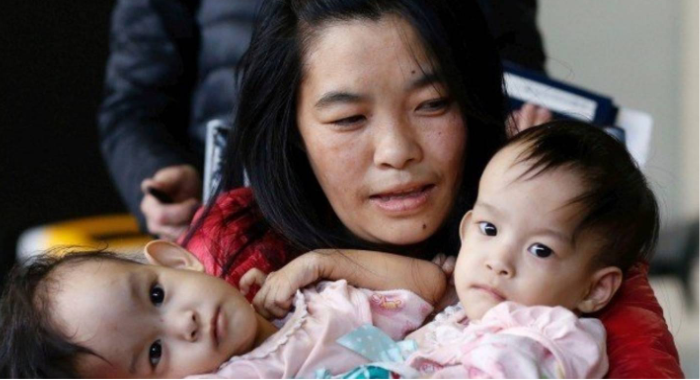 conjoined-twins-flown-from-bhutan-to-australia-for-separation-operation